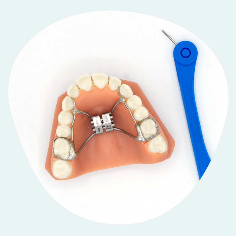 exemple d'appareil orthodontique
